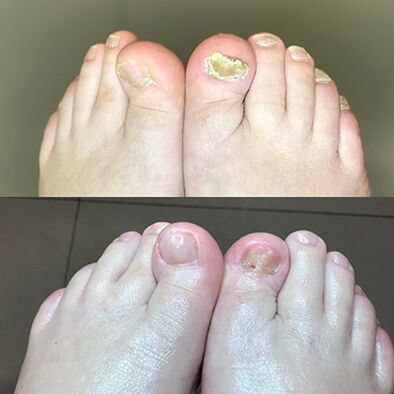 Experiencia no uso de prometeiros de barnabas de Israel, foto antes e despois