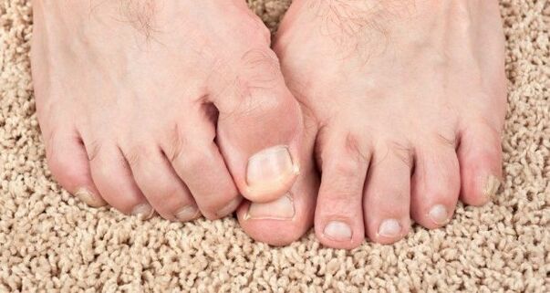 Síntomas do fungo das uñas