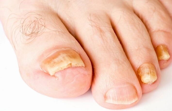 O cogomelo no polgar da perna