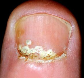 Síntomas e signos da enfermidade