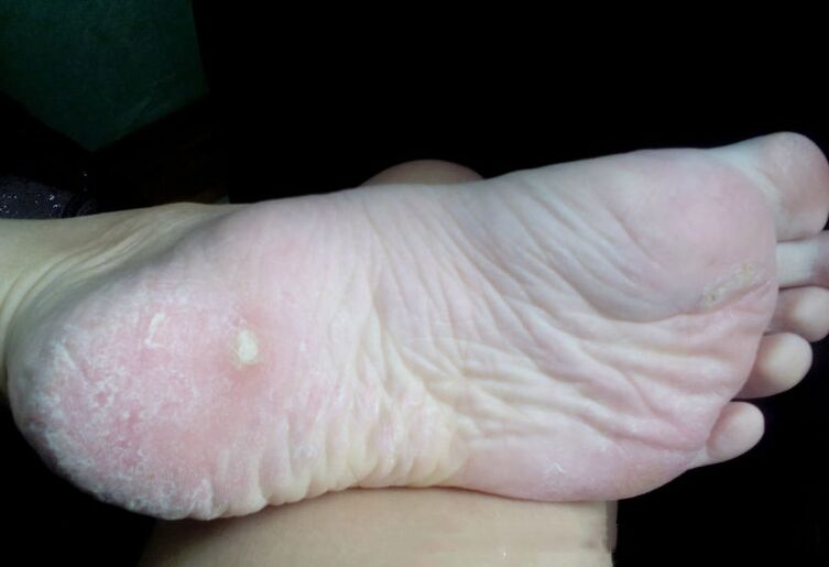 Tratamento do cogomelo cun láser