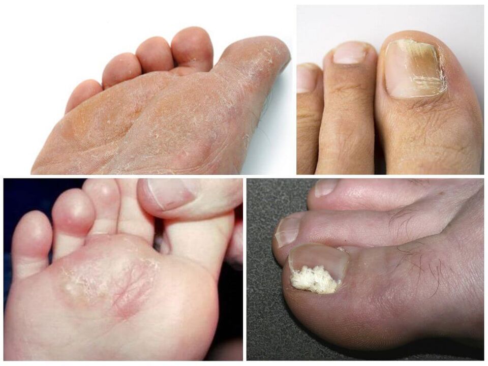 A etapa inicial do pé de atleta