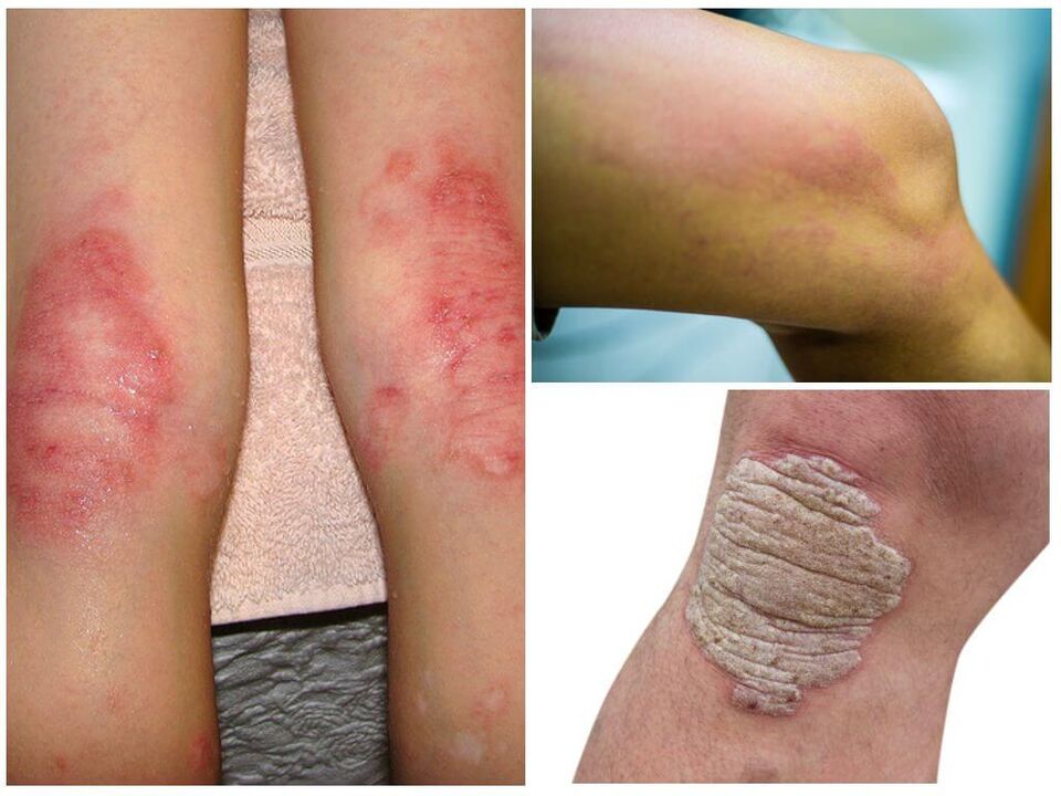 Infeccións fúngicas dos xeonllos