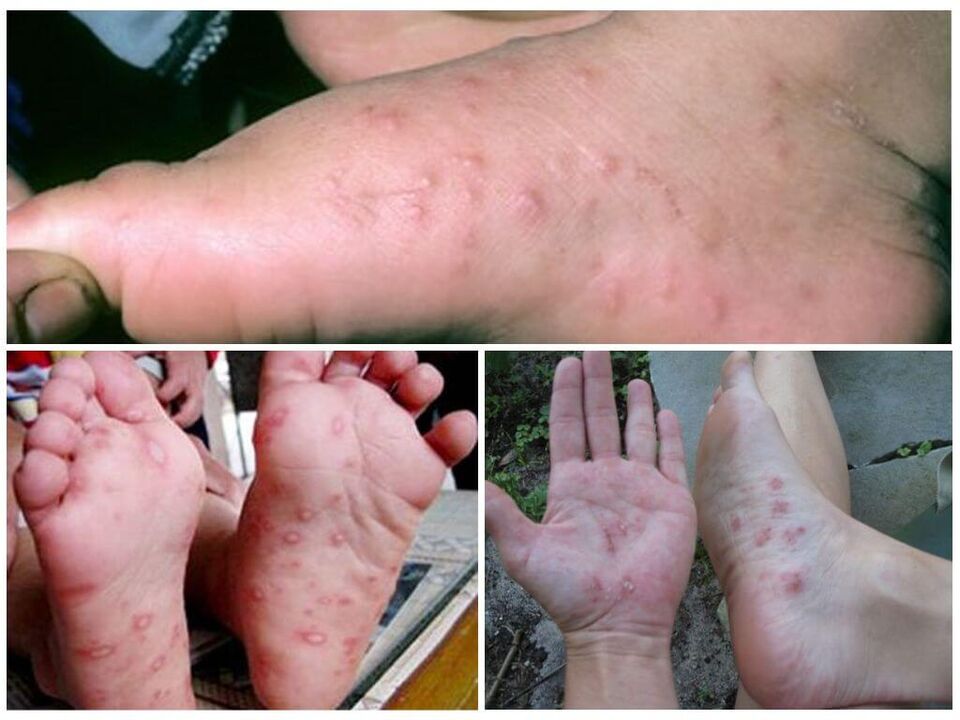 Lesións hiperqueratósicas dos pés