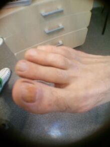 Fase inicial de fungo das unhas no dedo gordo do pé