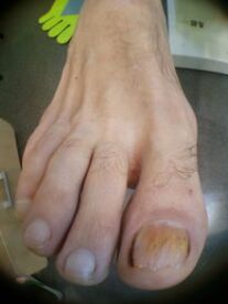 Fungo das unhas no dedo gordo do pé