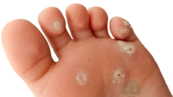 segunda fase dunha infección fúngica