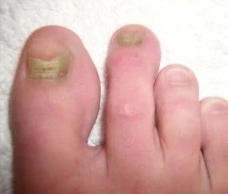 Unhas afectadas por fungos antes do tratamento