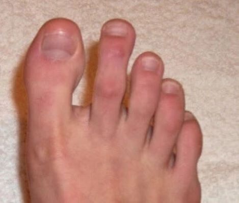 Unhas despois do tratamento con láser contra fungos
