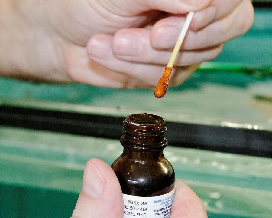 Aplicar unha mestura de iodo e zume de celidonia nas uñas dos pés elimina o fungo
