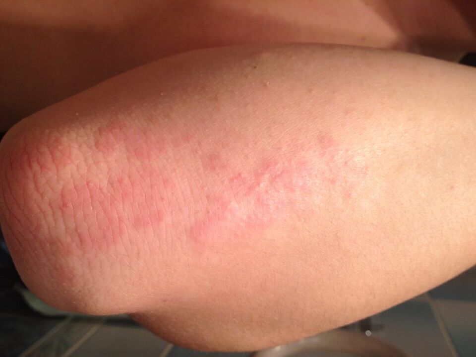 Unha reacción alérxica en forma de erupción na pel do cóbado despois de aplicar unha pinga de zume de celidonia